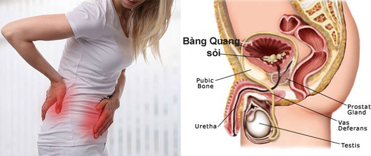 TÌM HIỂU VỀ SỎI BÀNG QUANG
