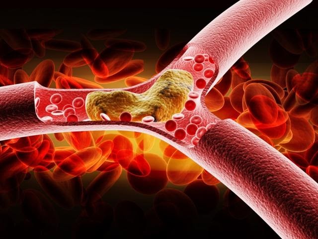 BỆNH MỠ MÁU CAO, GAN NHIỄM MỠ TĂNG NHANH Ở NGƯỜI TRẺ