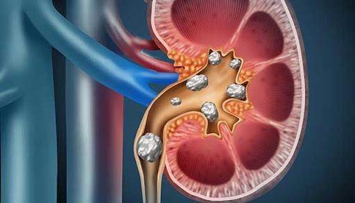 NHỮNG RỦI RO KHI PHẪU THUẬT SỎI THẬN