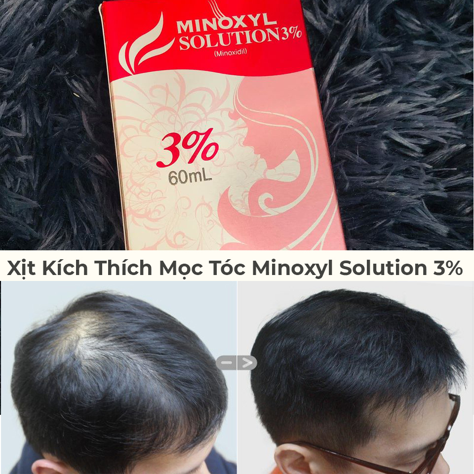 Uống thuốc giảm cân có gây rụng tóc không Lời giải đáp từ chuyên gia #43 Uống thuốc giảm cân có gây rụng tóc không Lời giải đáp từ chuyên gia
