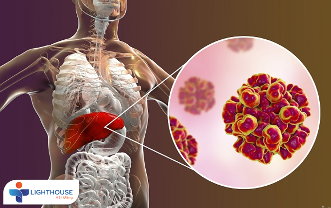 BỆNH VIÊM GAN C: NGUYÊN NHÂN VÀ TRIỆU CHỨNG