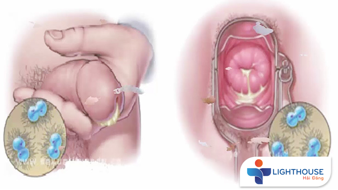 LẬU LÀ GÌ? NGUYÊN NHÂN VÀ DẤU HIỆU CẢNH BÁO BỆNH LẬU