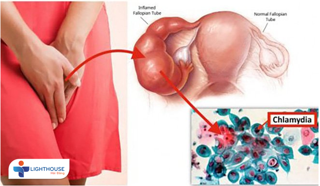 Triệu chứng bệnh Chlamydia? Những biến chứng không ngờ