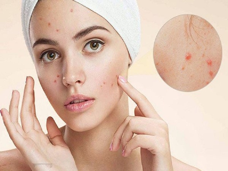 Phân loại và biểu hiện của chứng cá đỏ