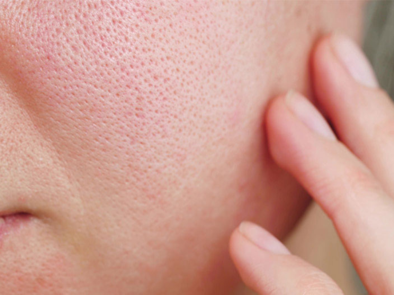 “BÓC TRẦN” SỰ THẬT VỀ THU NHỎ LỖ CHÂN LÔNG