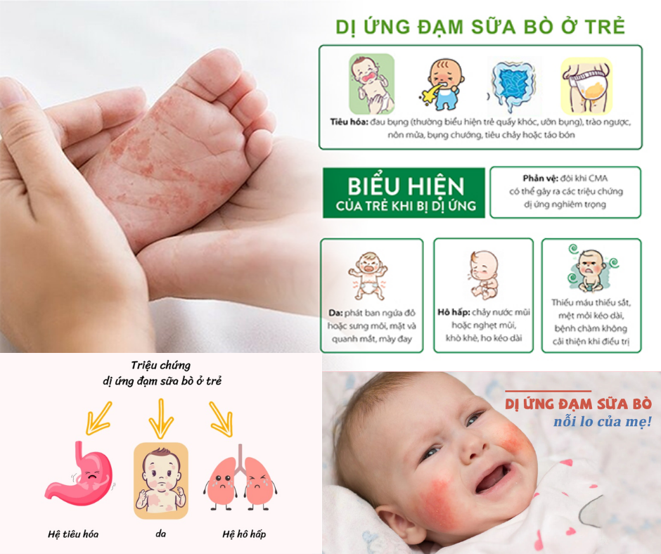 Tổng Quan Về Các Loại Sữa Dành Cho Trẻ Dị Ứng Đạm Sữa Bò: Chỉ Định, Mùi Vị, Tác Dụng Phụ Và Đánh Giá Lâm Sàng