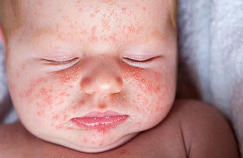 Dấu Hiệu Dị Ứng Đạm Bò Ở Trẻ Em: Nhận Biết Sớm Để Tránh Nguy Hiểm