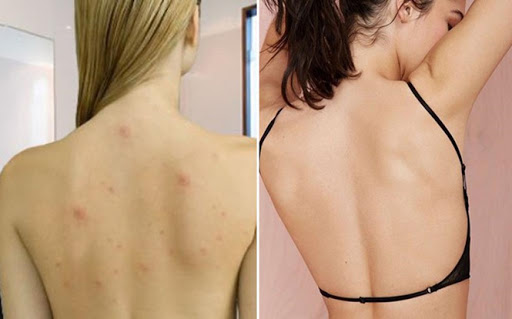 Cách trị mụn lưng giúp nàng khoe trọn tấm lưng ong quyến rũ Cách trị mụn lưng giúp nàng khoe trọn tấm lưng ong quyến rũ