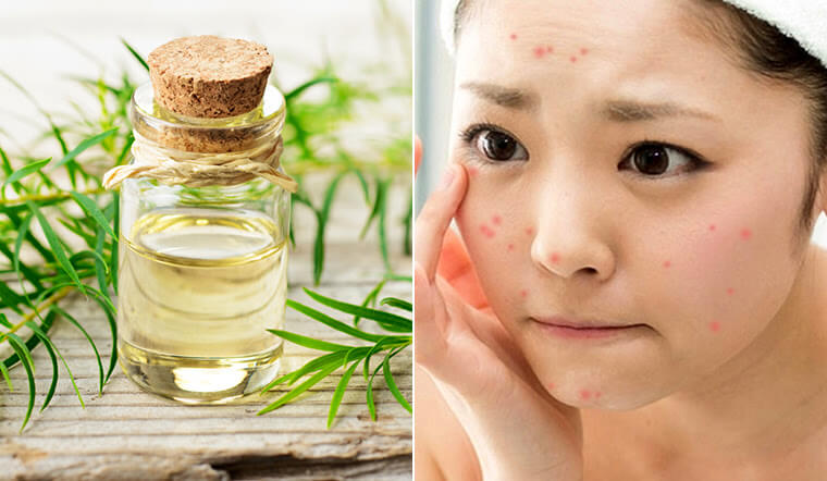 tinh dầu tràm trị mụn