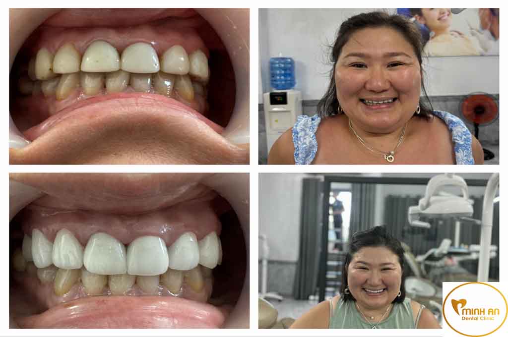 Керамические зубы в Дананге