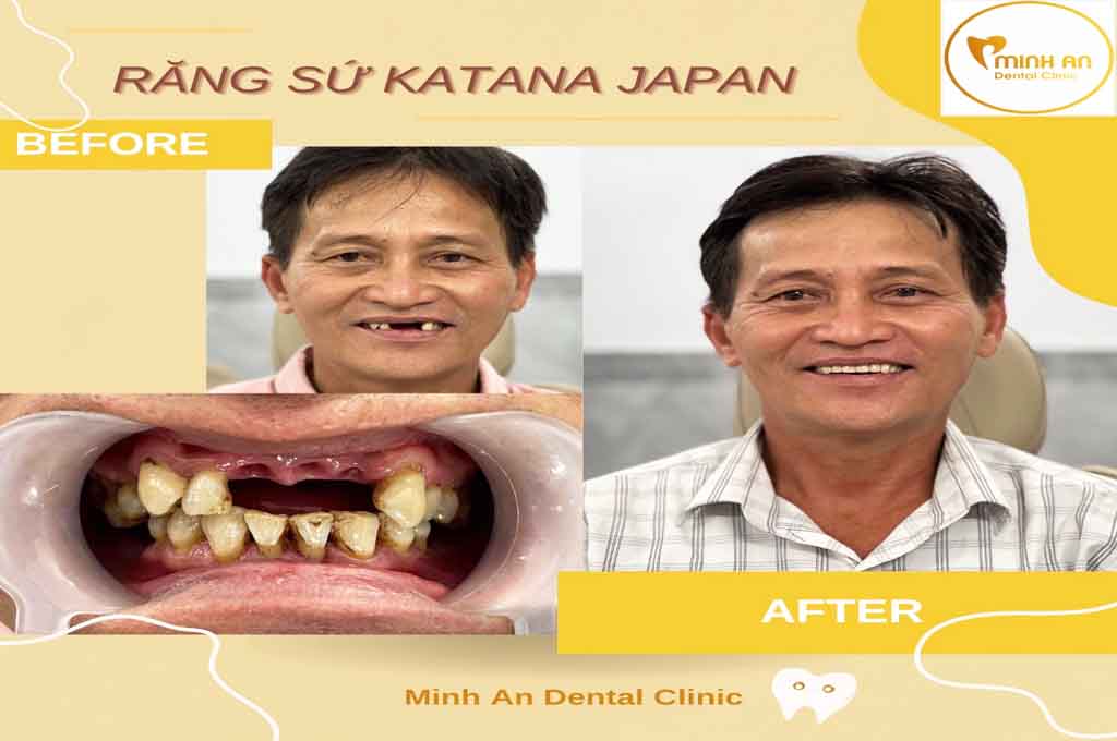 Làm Răng Đẹp Đà Nẵng