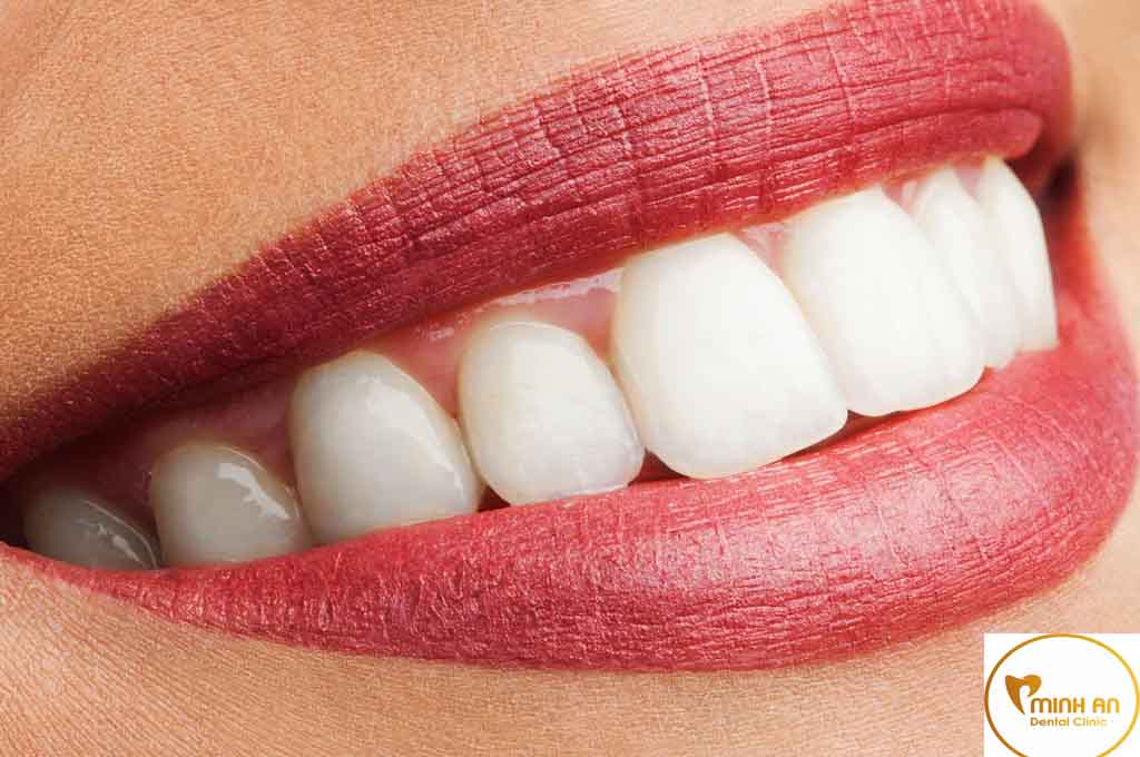 Lam Răng Thẩm Mỹ