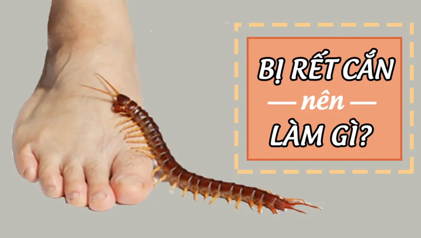 Cách Xử Lý Khi Bị Rết Cắn