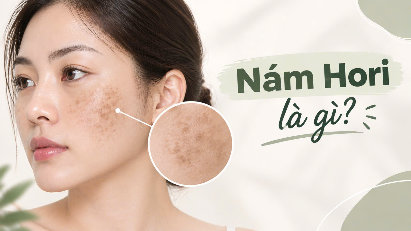 Nám Chân Sâu Hori Là Gì? Nguyên Nhân Và Cách Điều Trị