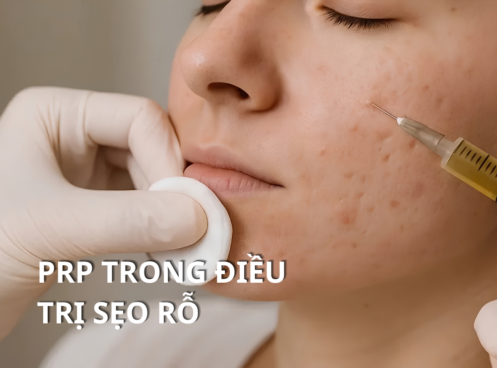 Tất Tần Tật Về PRP Trong Điều Trị Sẹo Rỗ