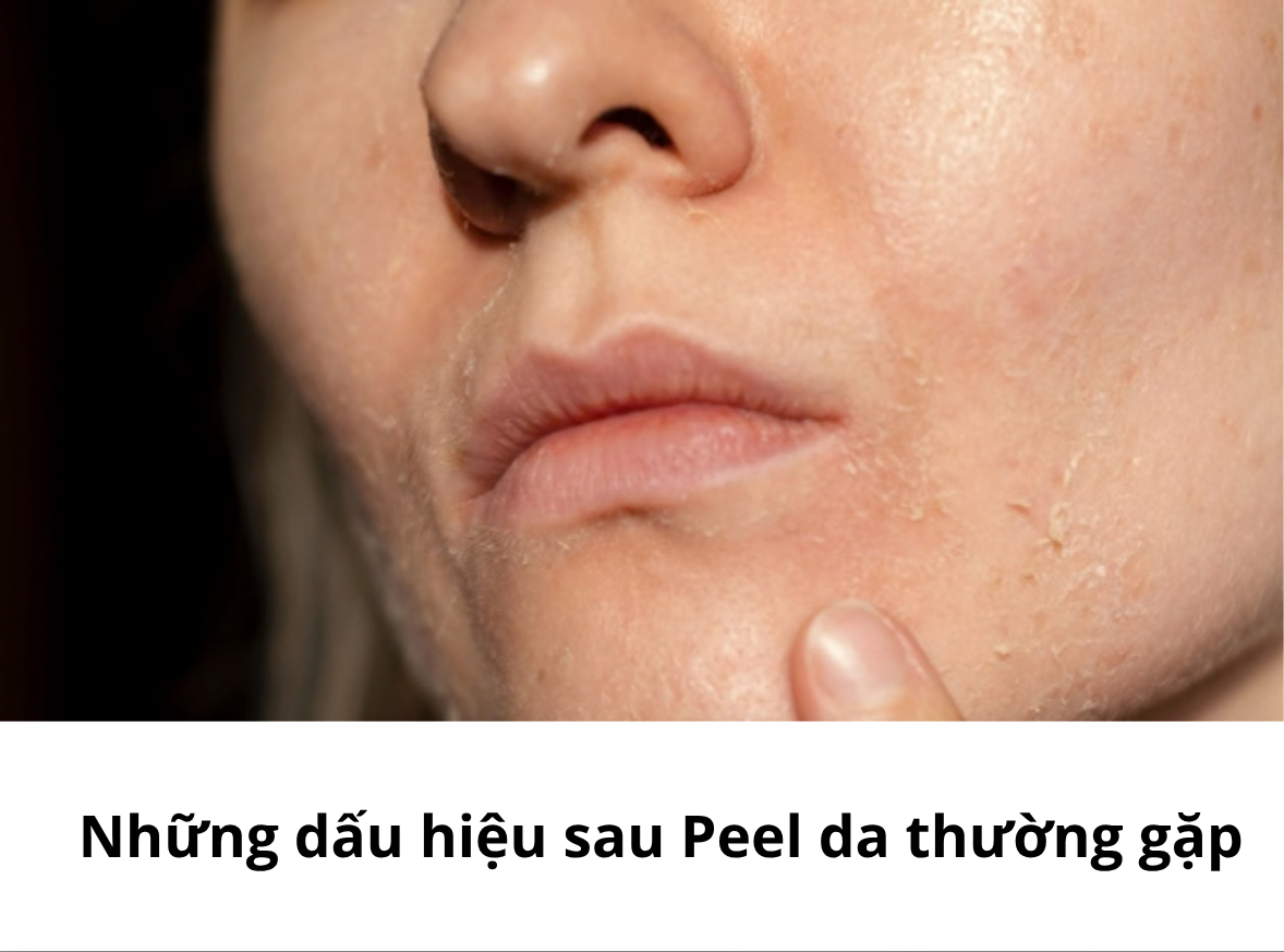 Những Dấu Hiệu Sau Peel Da Thường Gặp Và Cách Chăm Sóc Chuẩn Y Khoa