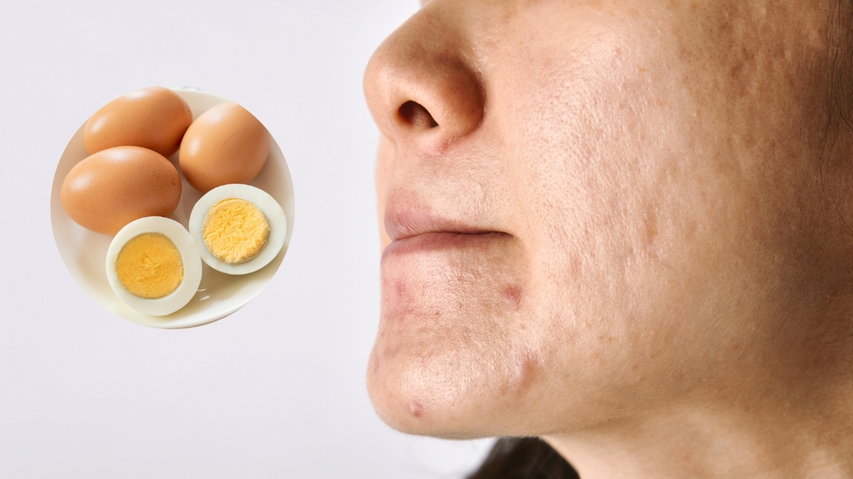 Bị sẹo kiêng ăn trứng bao lâu? Cách để làm phẳng và mờ sẹo
