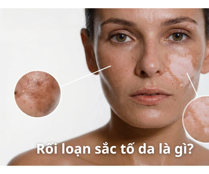 Bị Rối Loạn Sắc Tố Da Có Chữa Được Không?