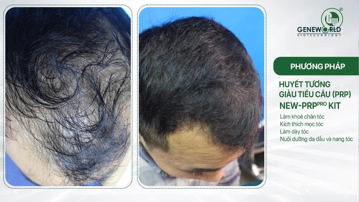 Cách điều trị rụng tóc hiệu quả được chuyên gia khuyên thực hiện