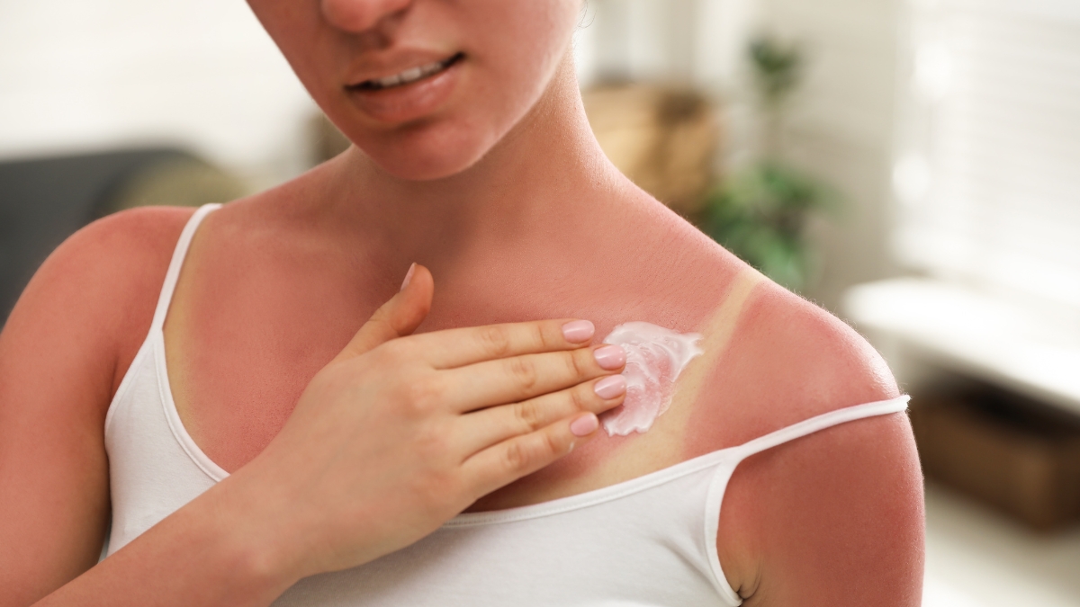 Da mặt sẽ thế nào nếu không được thoa kem chống nắng?