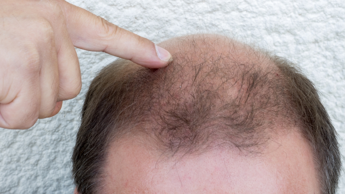 10 nguyên nhân rụng tóc ở nam giới và cách khắc phục