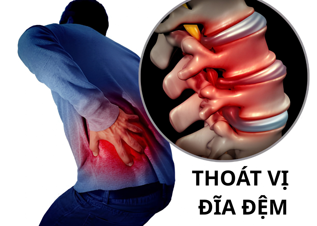 Có Nên Điều Trị Thoát Vị Đĩa Đệm Bằng Huyết Tương Giàu Tiểu Cầu PRP? Những Điều Cần Biết