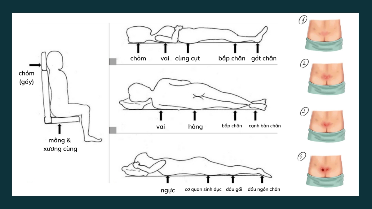 Cách phòng ngừa loét tì đè cho bệnh nhân nằm lâu