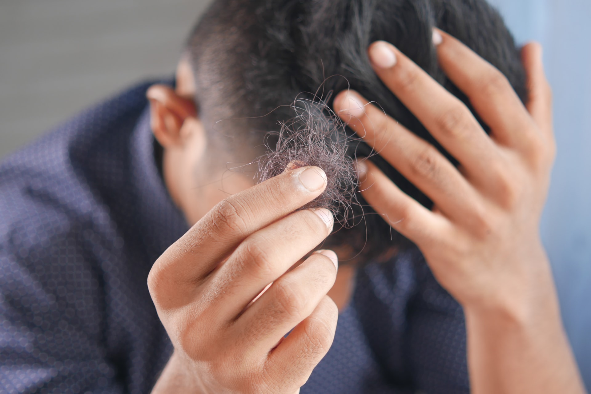 Tóc rụng nhiều ở nam giới là do đâu  VITA Clinic