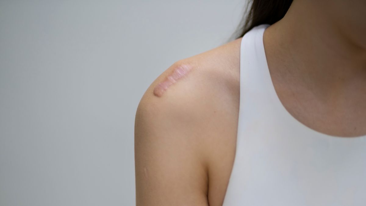 Sẹo lồi là gì? Giải pháp tối ưu hiệu quả trị sẹo lồi cho Spa, Clinic
