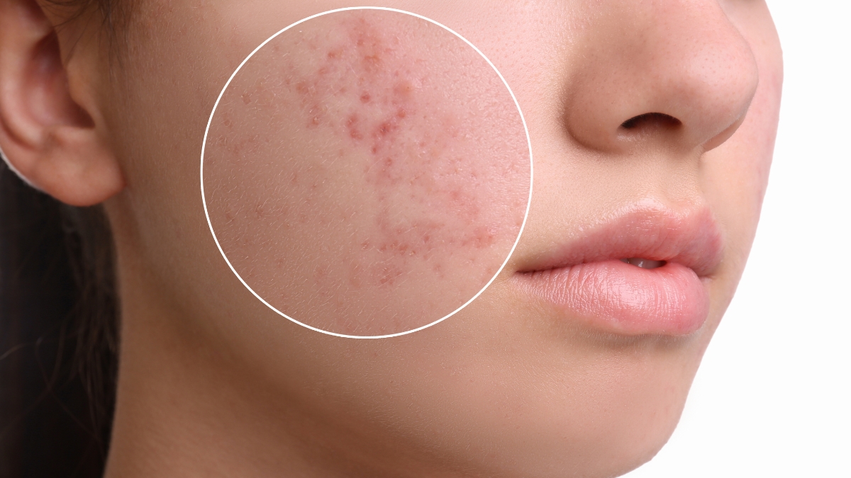 Sẹo lõm bôi gì giúp làm phẳng và mờ sẹo hiệu quả?