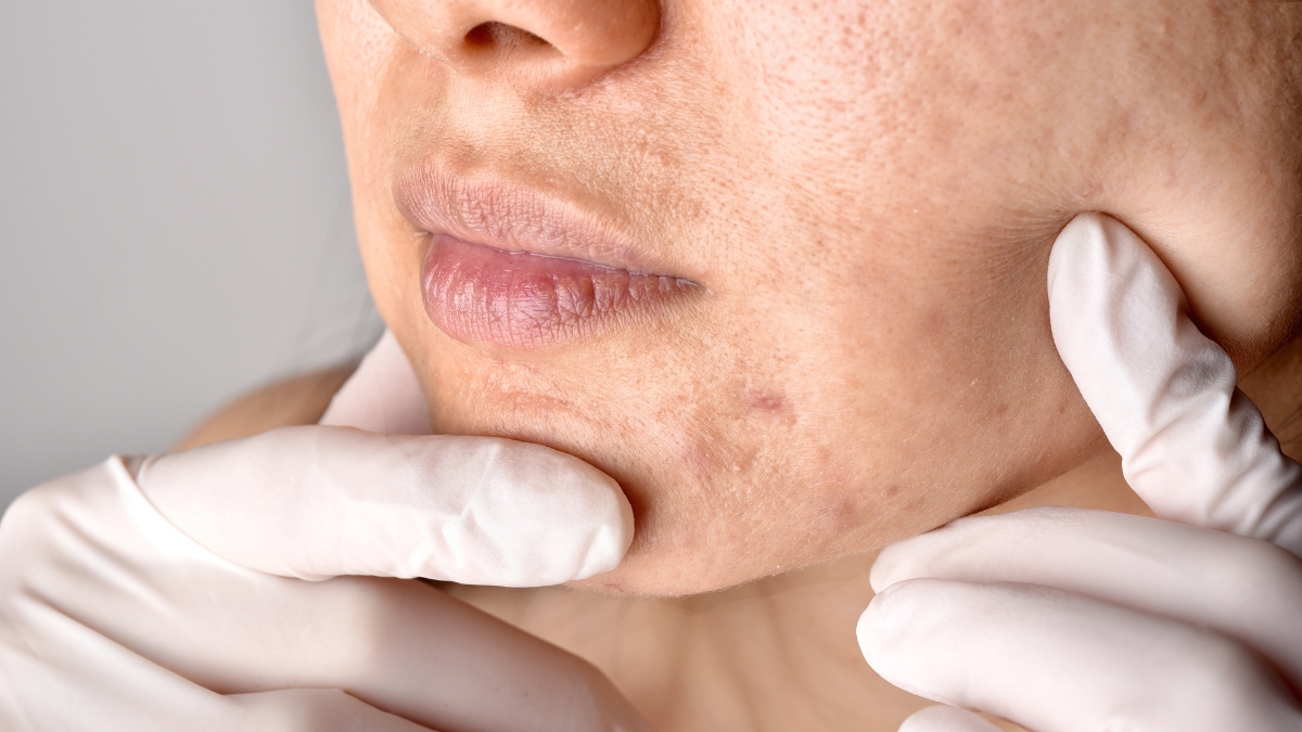 Gợi ý phác đồ trị sẹo rỗ mặt chuẩn y khoa cho Spa, Clinic