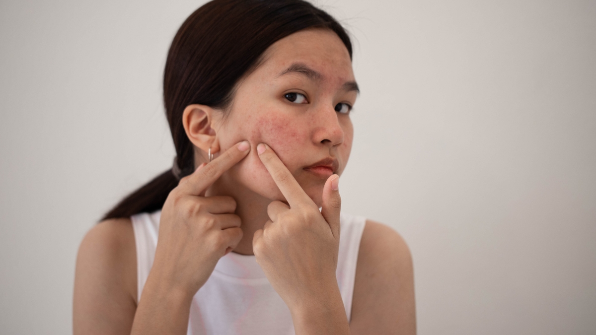 Sẹo rỗ nặng do mụn: Nguyên nhân và cách điều trị hiệu quả