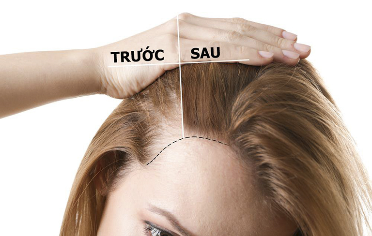 Thuốc mọc tóc Sato Arovics Solutions 5% Nhật Bản 30ml