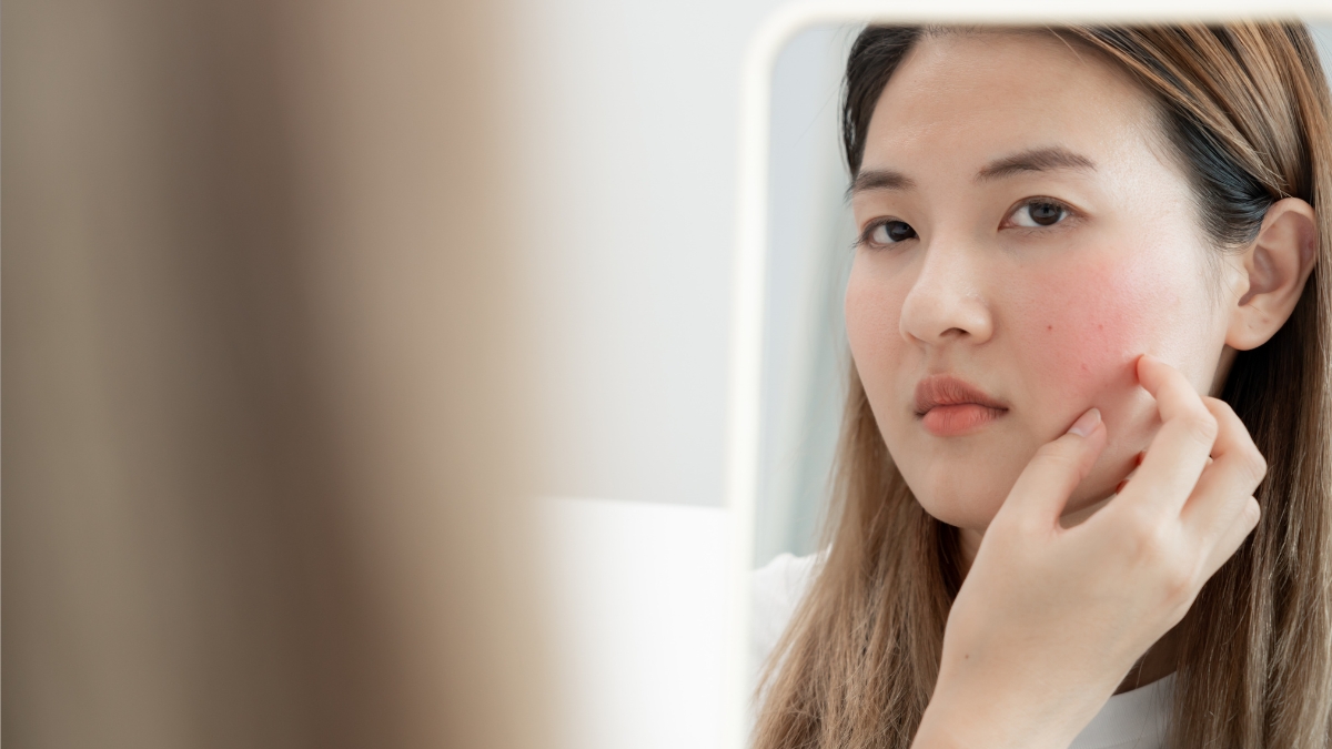 Tự thải độc da nhiễm corticoid đúng cách