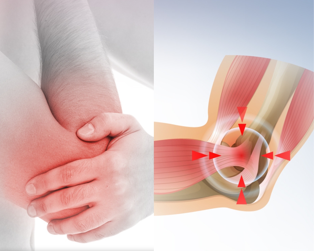 Viêm điểm bám gân