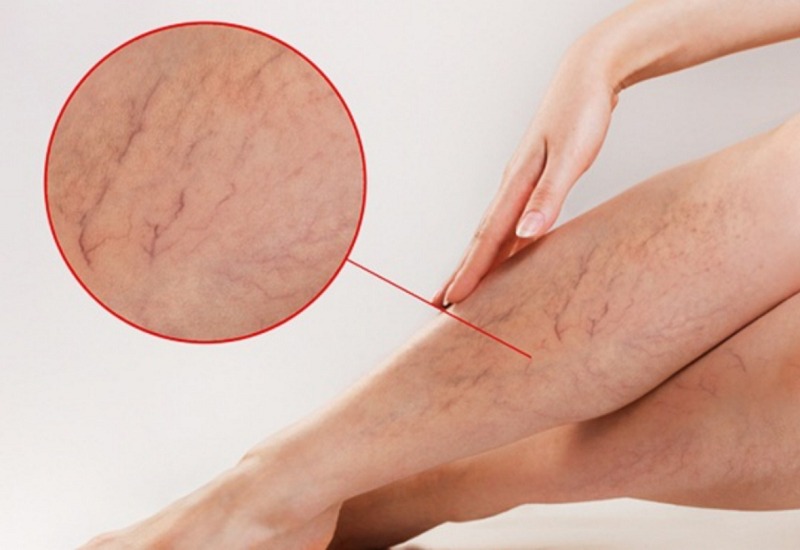 Triệu chứng phổ biến của giãn tĩnh mạch
