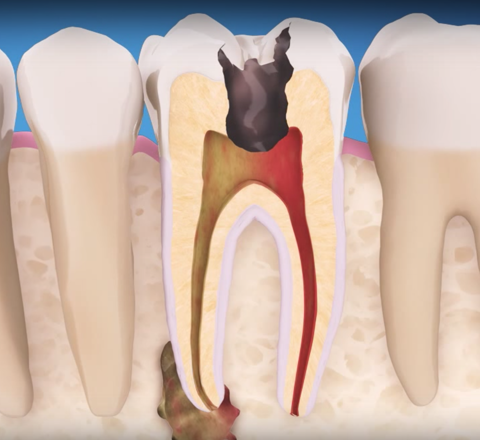 5 LÝ DO KHIẾN BẠN KHÔNG NÊN TRÌ HOÃN ĐIỀU TRỊ TỦY