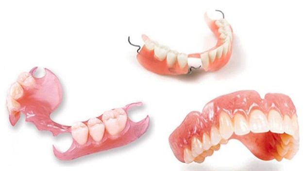 Trồng răng giả có những loại nào? Ưu và nhược điểm của từng loại