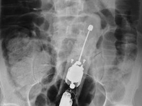 Dương vật giả 23 cm mắc trong bụng người đàn ông