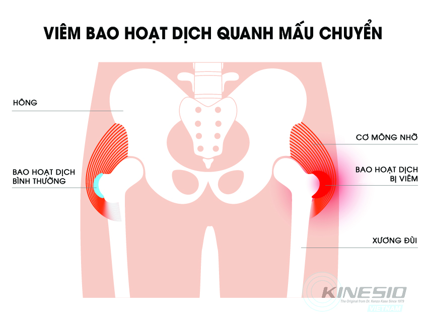 Trochanteric Bursitis