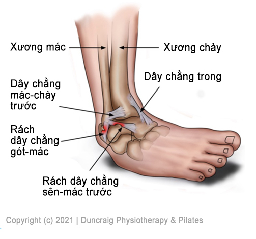 Giải phẫu chấn thương Bong gân