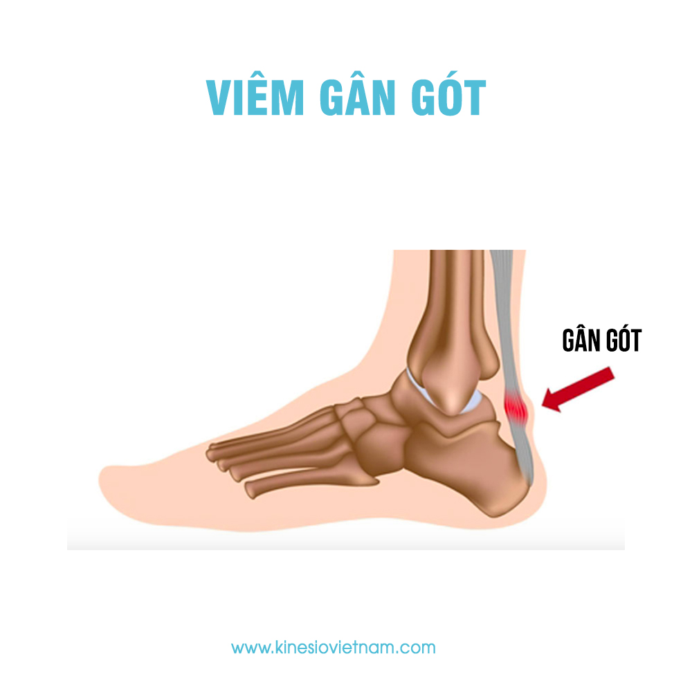Viêm gân gót