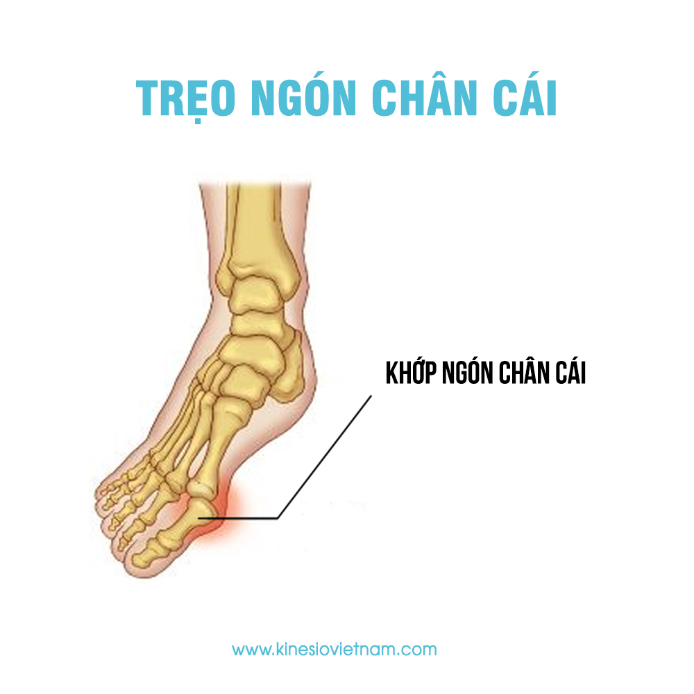 Trẹo ngón chân cái