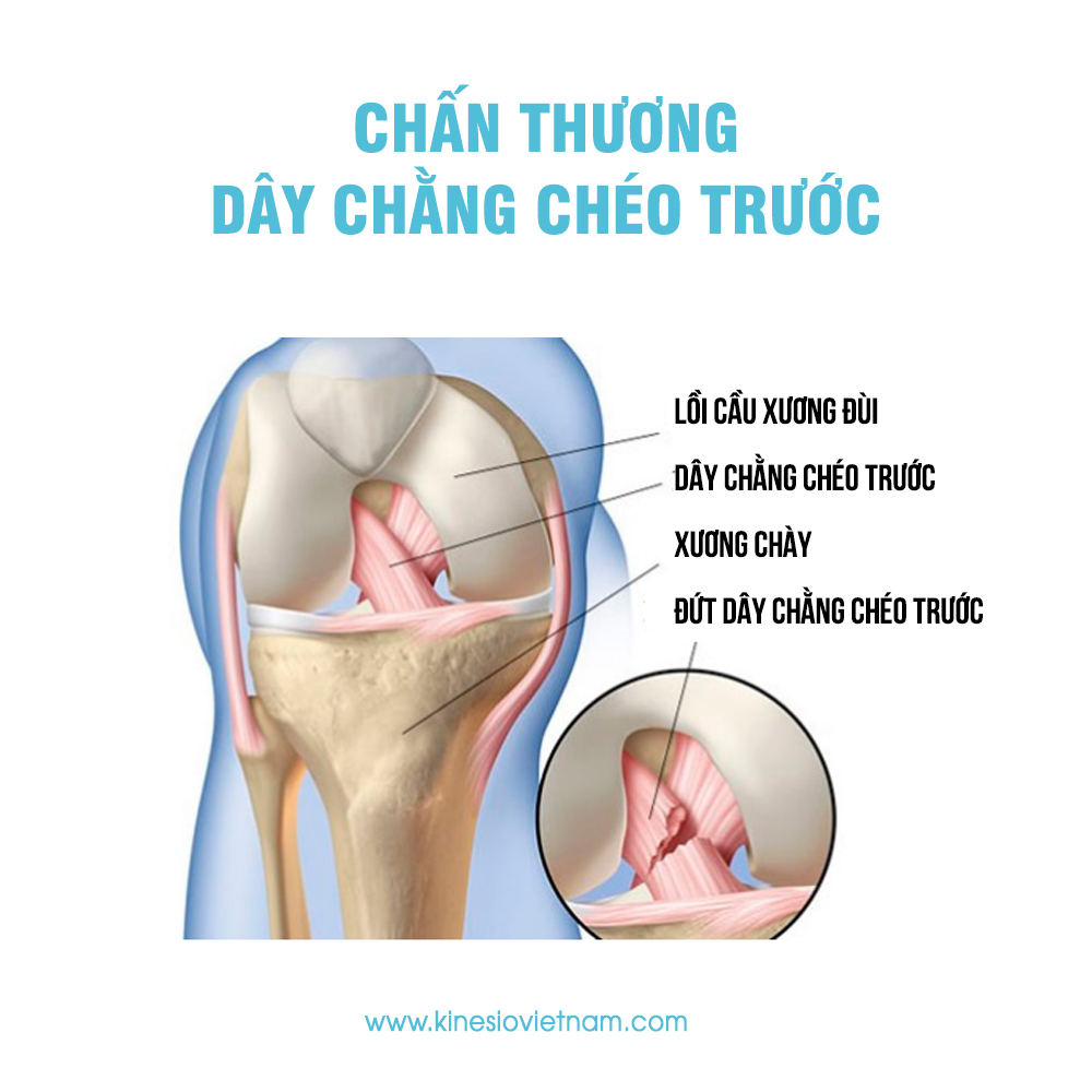 Chấn thương dây chằng chéo trước