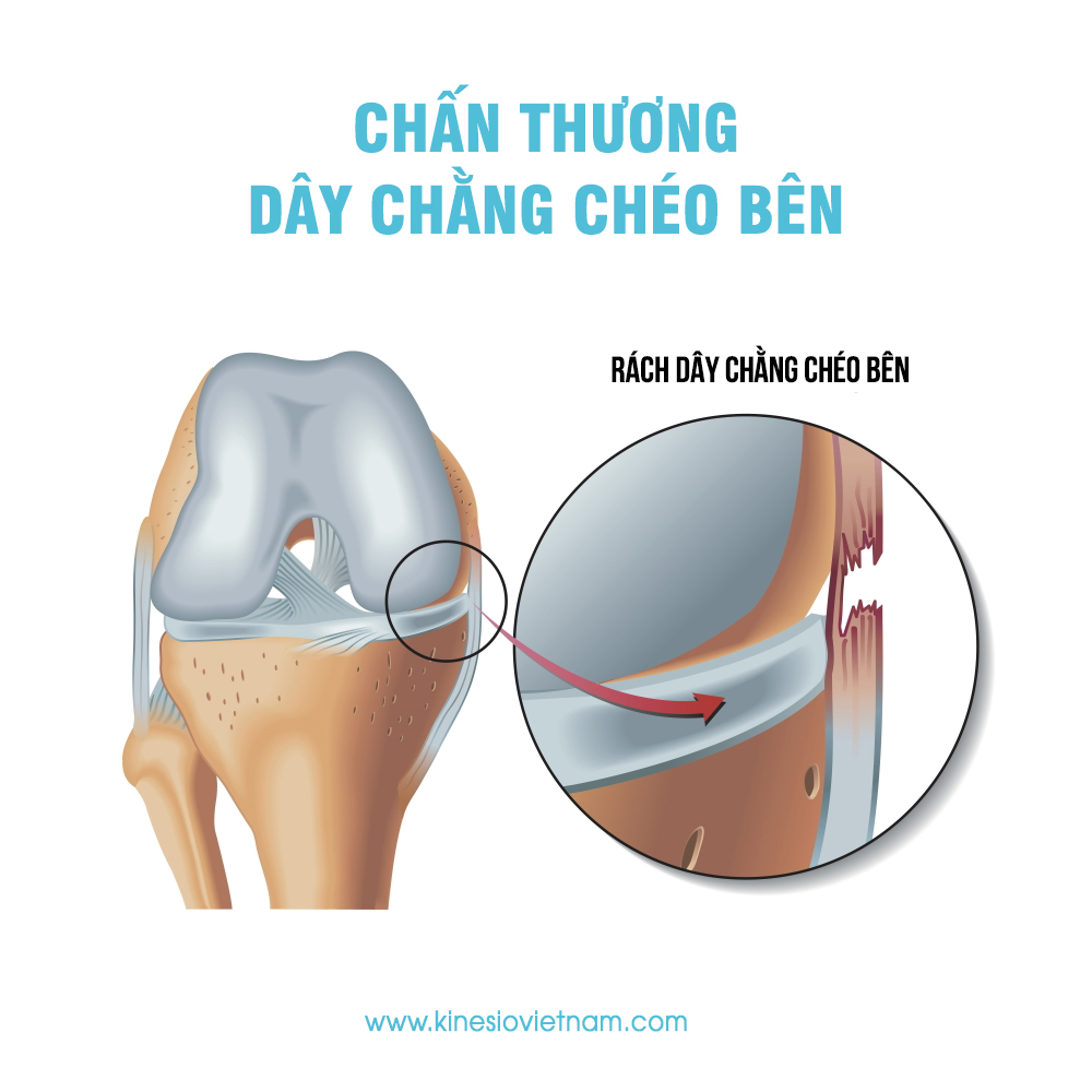 Chấn thương dây chằng chéo bên