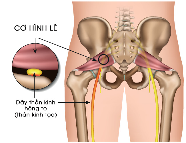 Hội chứng Cơ hình lê