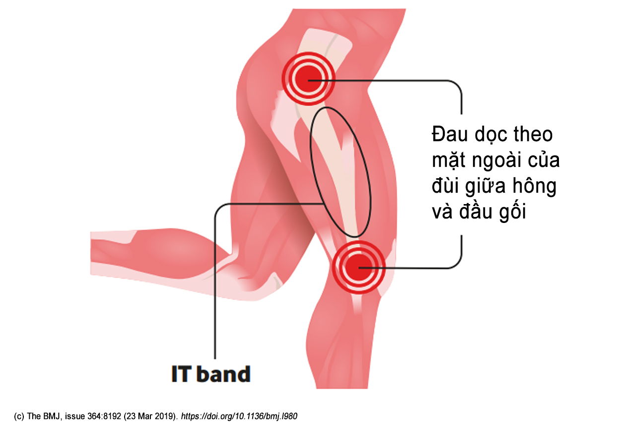 Điểm đau - Hội chứng IT Band