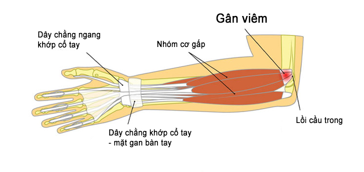 Viêm gân ở hội chứng Golfer's Elbow