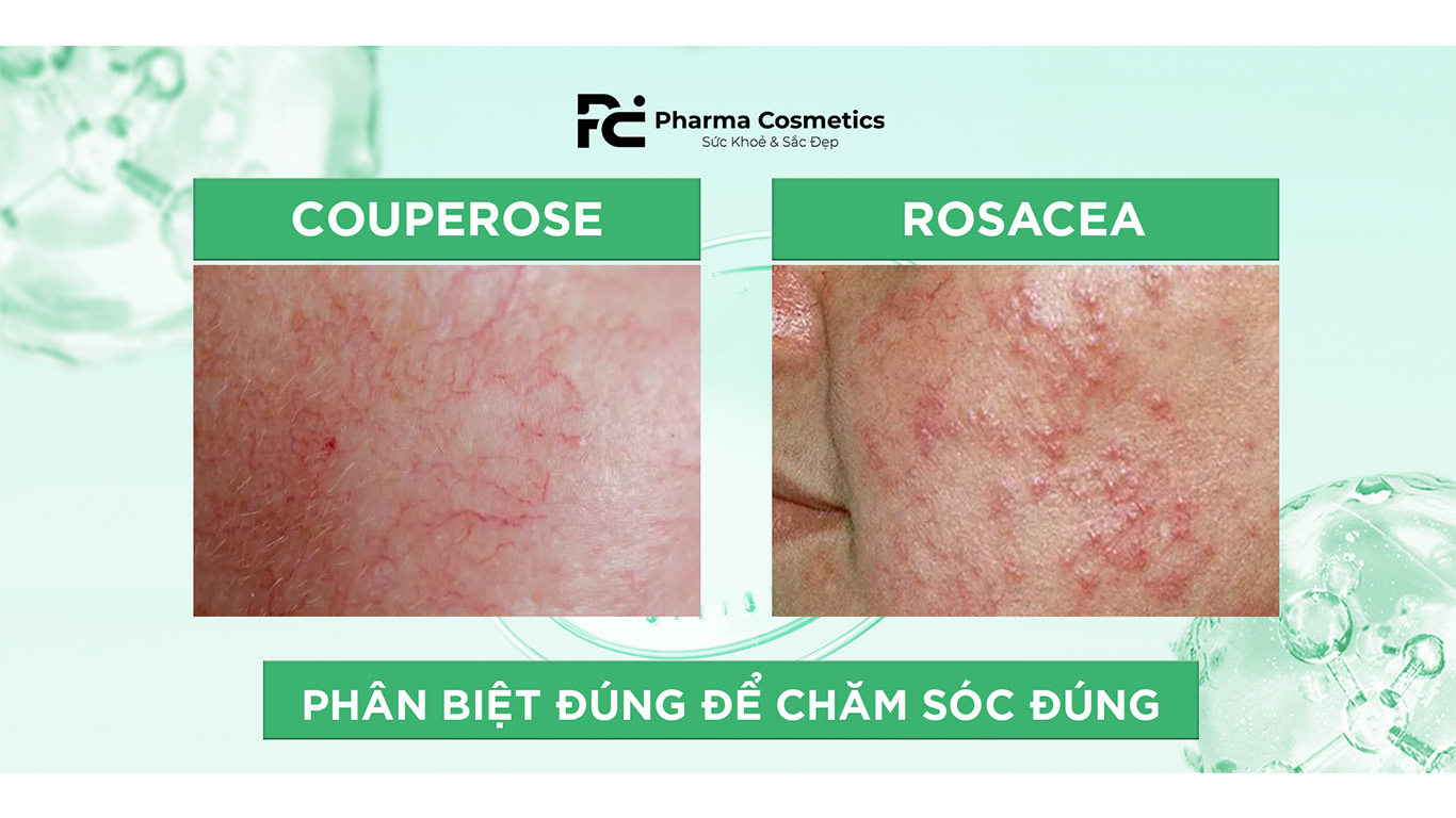 Phân Biệt Couperose và Rosacea: Hiểu Rõ Làn Da Đỏ để Chăm Sóc Đúng Cách
