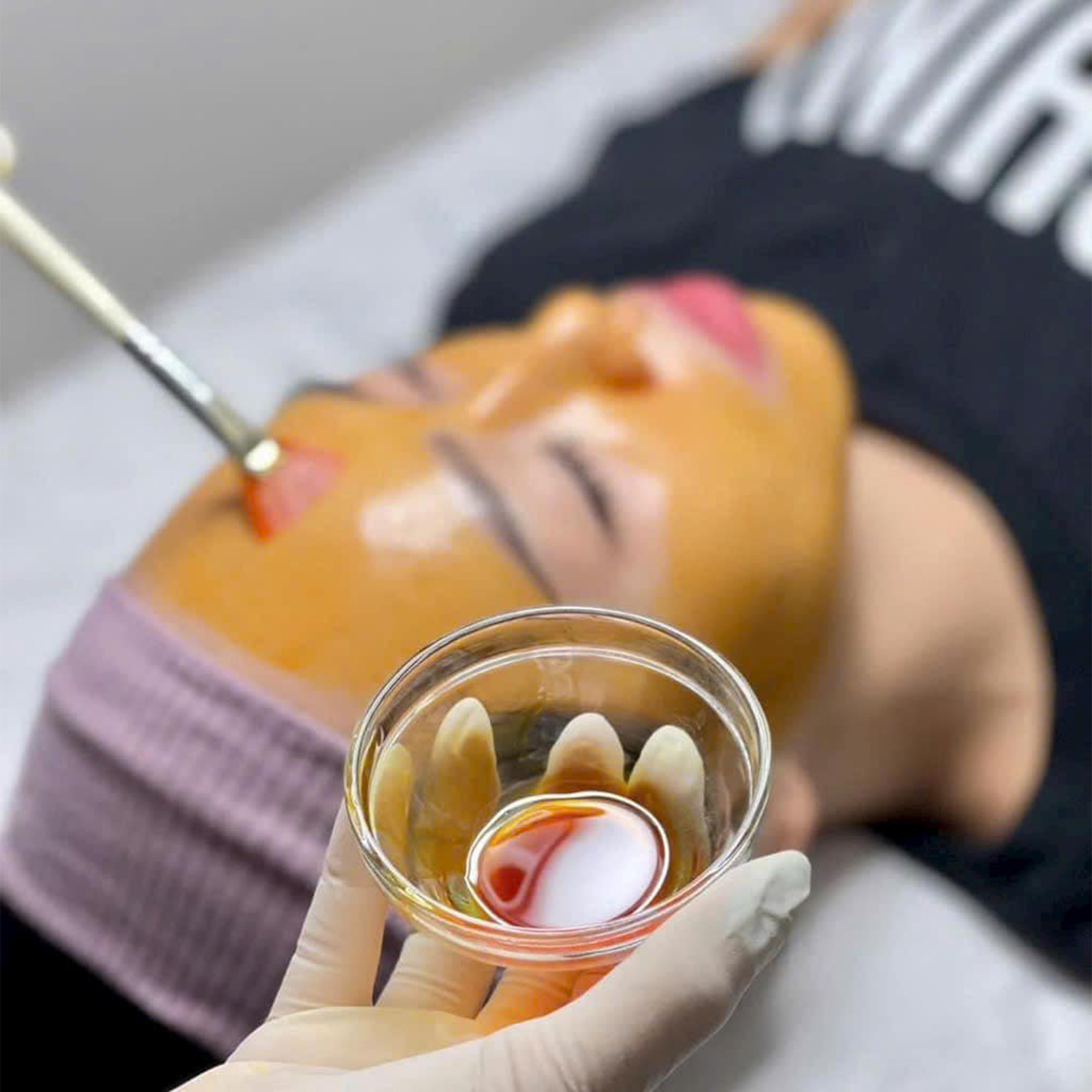 MESOPEEL® MD MELANOSTOP TRANEX: Giải Pháp Peel Đặc Trị Nám & Tăng Sắc Tố Chuyên Sâu